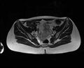 Bicornuate bicollis uterus (Radiopaedia 61626-69616 Axial T2 13).jpg