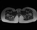 Bicornuate bicollis uterus (Radiopaedia 61626-69616 Axial T2 43).jpg