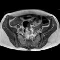 Bicornuate uterus (Radiopaedia 61974-70046 Axial T1 20).jpg