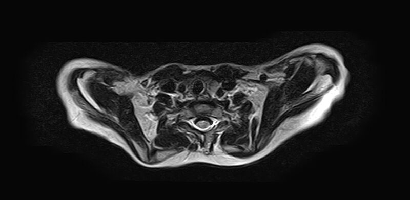 File:Bilateral Sprengel deformity with Klippel-Feil syndrome (Radiopaedia 66395-75650 Axial T2 18).jpg