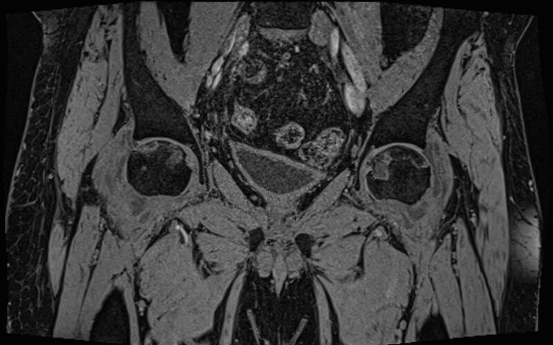 File:Bilateral avascular necrosis of femoral head (Radiopaedia 77116-89078 Coronal T2 we 51).jpg