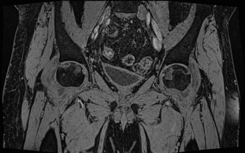 Bilateral avascular necrosis of femoral head (Radiopaedia 77116-89078 Coronal T2 we 51).jpg