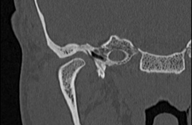 File:Bilateral cholesteatoma (Radiopaedia 54898-61172 Coronal bone window 13).jpg