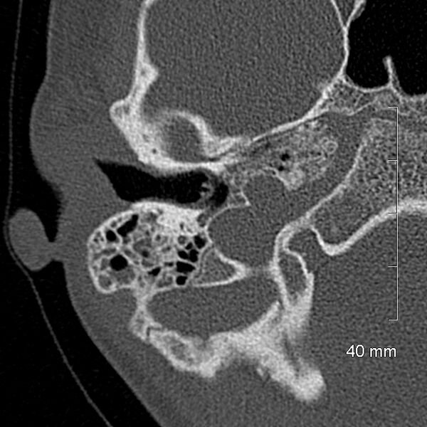 File:Bilateral grommets (Radiopaedia 47710-52404 Axial bone window 23).jpg