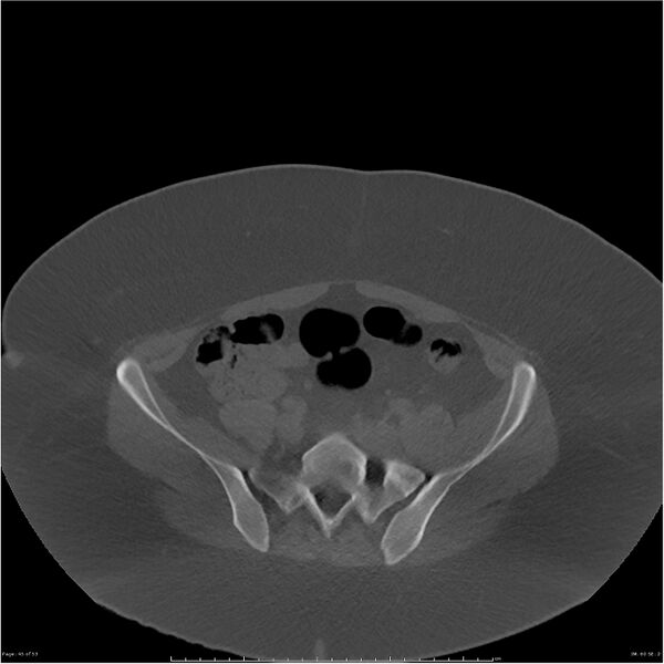 File:Bilateral lumbar ribs (Radiopaedia 25862-26010 bone window 45).jpg