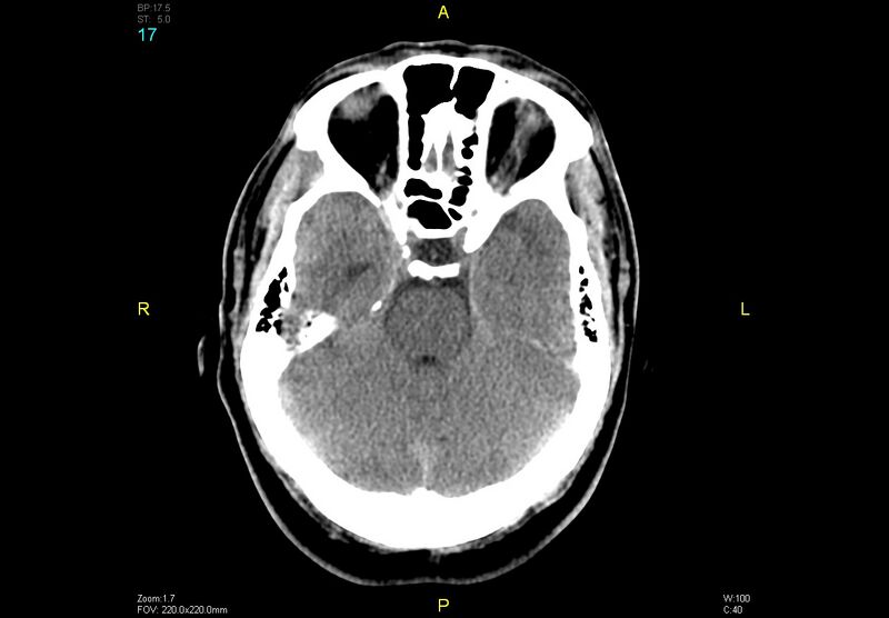 File:Bilateral medial medullary infarction (Radiopaedia 42220-45295 Axial non-contrast 17).jpg