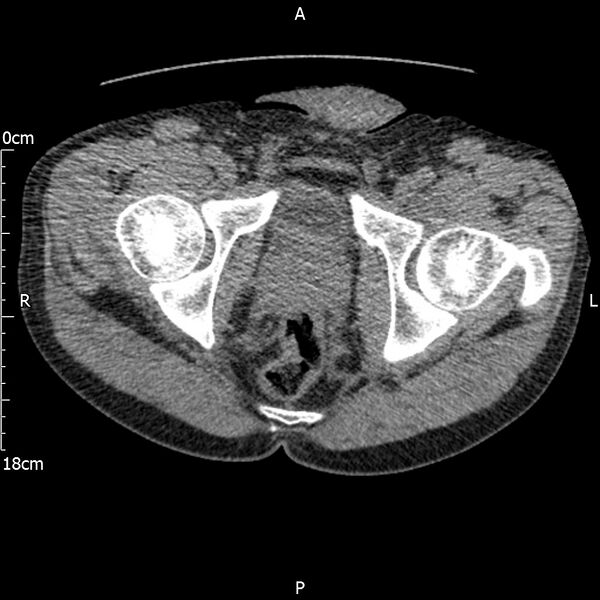File:Bilateral medullary nephrocalcinosis with ureteric calculi (Radiopaedia 71269-81569 Axial non-contrast 130).jpg