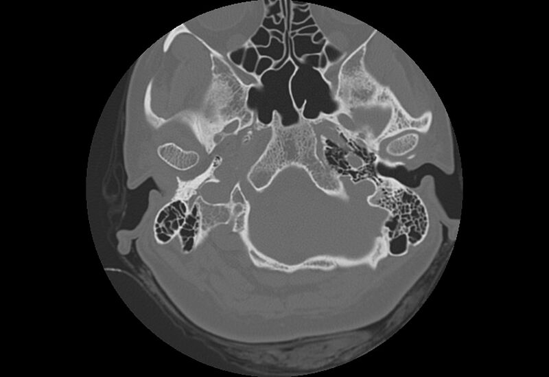 File:Bilateral otospongiosis (Radiopaedia 35447-36940 Axial bone window 11).jpg