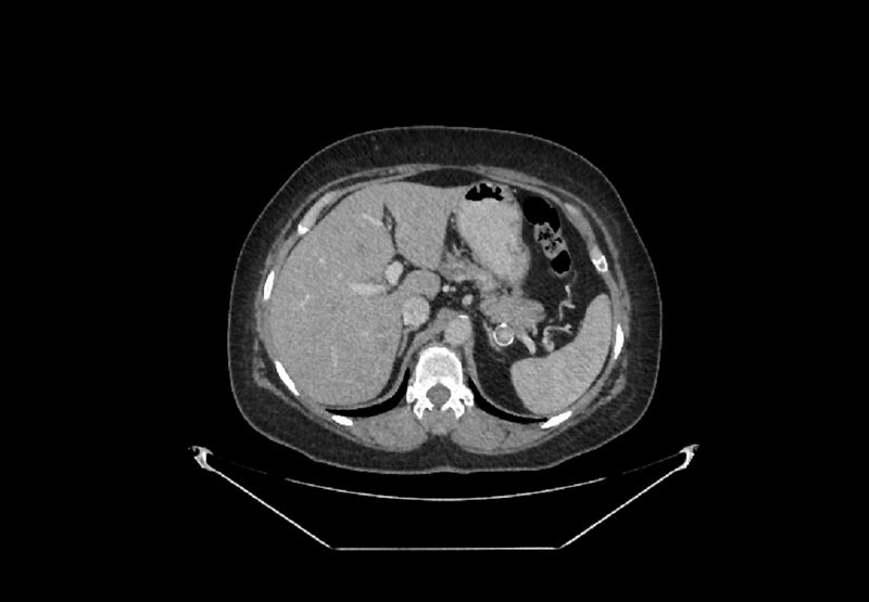 File:Bilateral urolithiasis with incidentally detected splenic artery aneurysm and left inferior vena cava (Radiopaedia 44467-48127 B 9).jpg