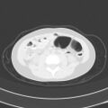 Bochdalek diaphragmatic hernia (Radiopaedia 38866-41059 Axial lung window 34).jpg