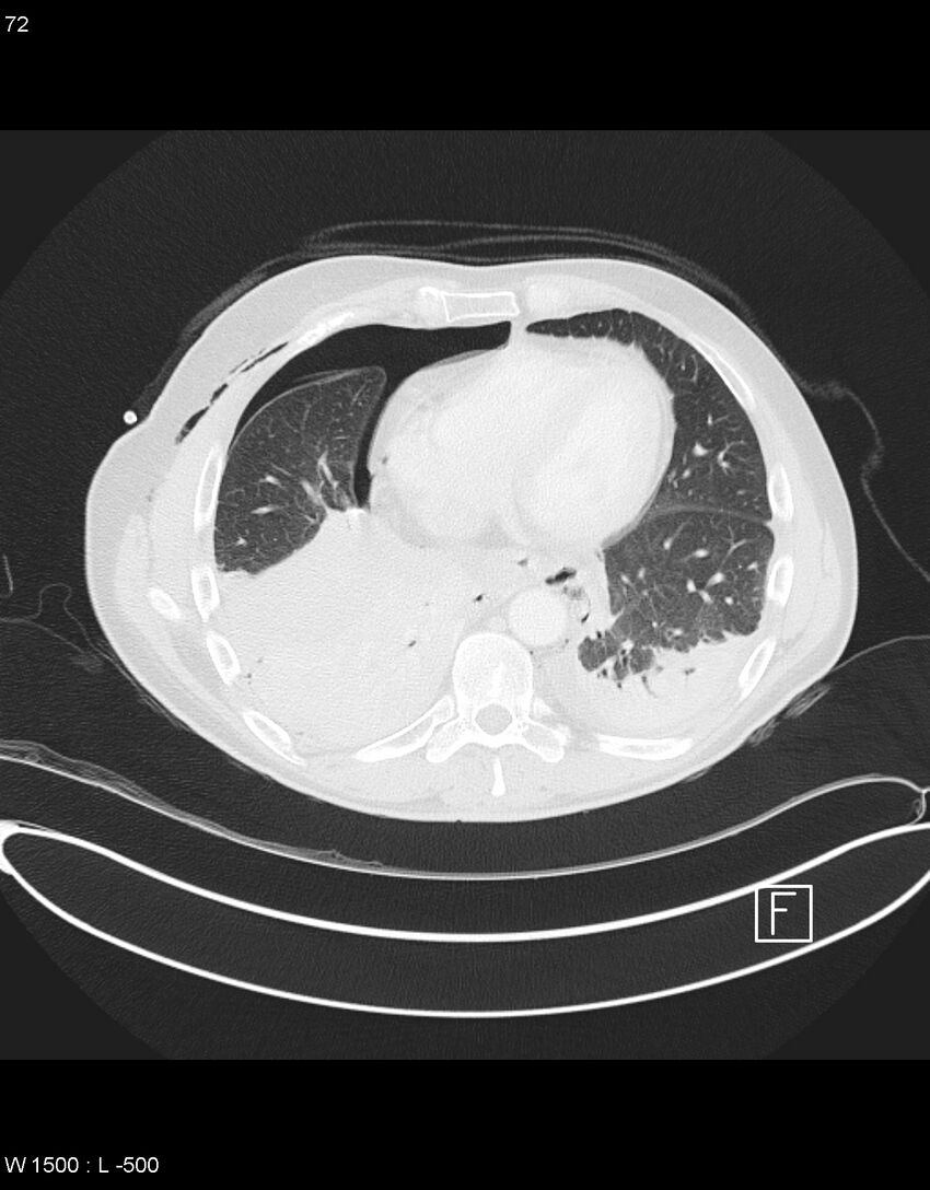 Boerhaave syndrome with tension pneumothorax (Radiopaedia 56794-63605 Axial lung window 35).jpg
