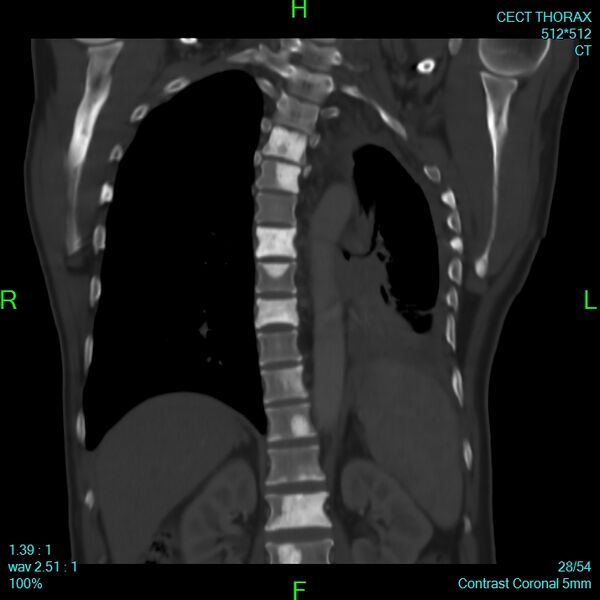 File:Bone metastases from lung carcinoma (Radiopaedia 54703-60937 Coronal bone window 28).jpg