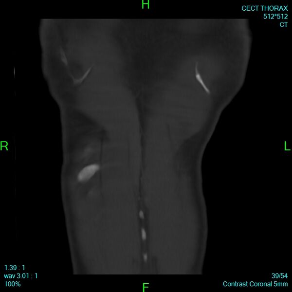 File:Bone metastases from lung carcinoma (Radiopaedia 54703-60937 Coronal bone window 39).jpg