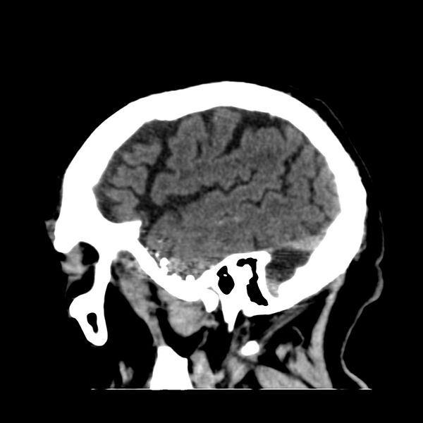 File:Brain Pantopaque remnants (Radiopaedia 78403-91048 C 45).jpg