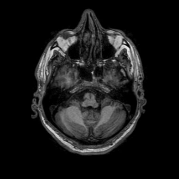 File:Brain abscess complicated by intraventricular rupture and ventriculitis (Radiopaedia 82434-96577 Axial T1 11).jpg