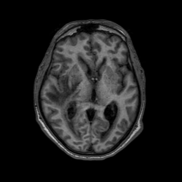 File:Brain abscess complicated by intraventricular rupture and ventriculitis (Radiopaedia 82434-96577 Axial T1 33).jpg