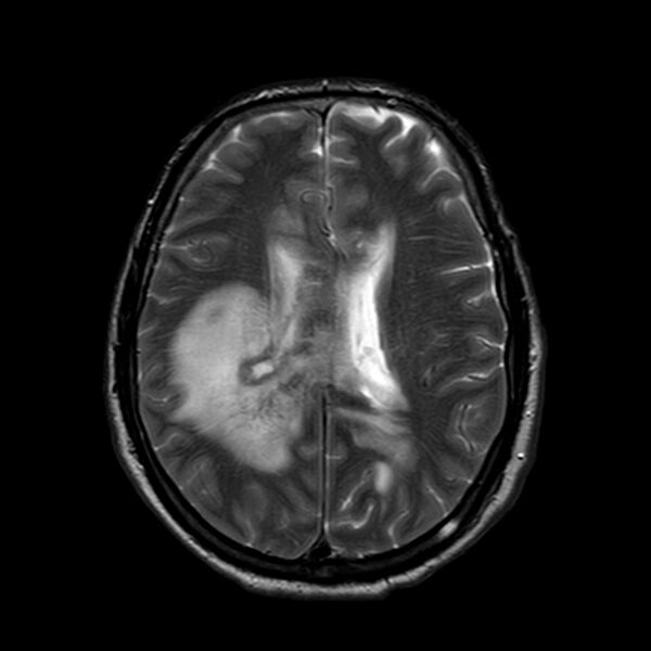 File:Brain abscess complicated by intraventricular rupture and ventriculitis (Radiopaedia 82434-96577 Axial T2 15).jpg