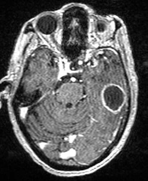 File:Brain abscess with dual rim sign (Radiopaedia 87566-103938 Axial T1 C+ 58).jpg