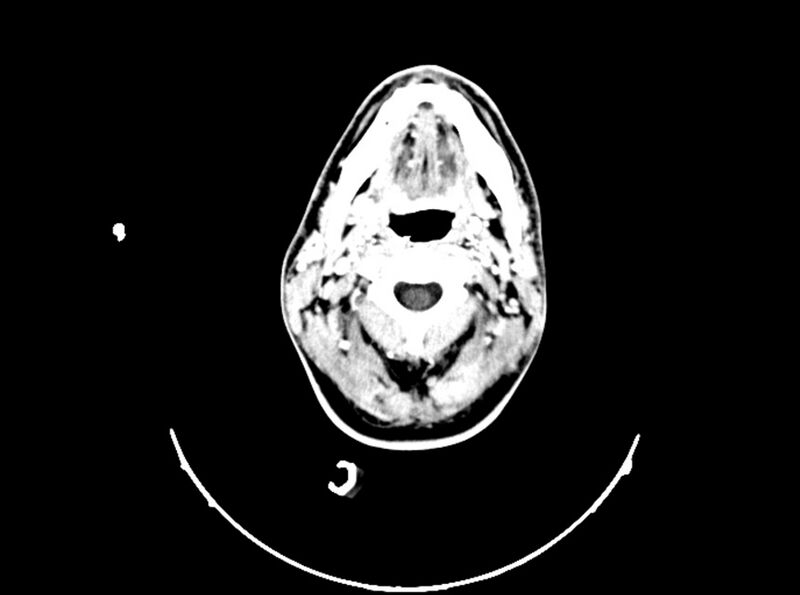 File:Brain injury by firearm projectile (Radiopaedia 82068-96088 B 36).jpg