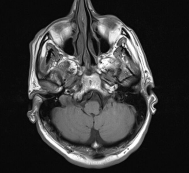 File:Brain metastases - lung cancer primary (Radiopaedia 75060-86115 Axial T1 6).jpg