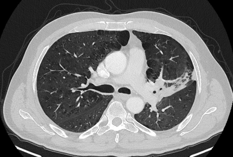 File:Brain metastases - lung cancer primary (Radiopaedia 75060-86116 Axial lung window 23).jpg