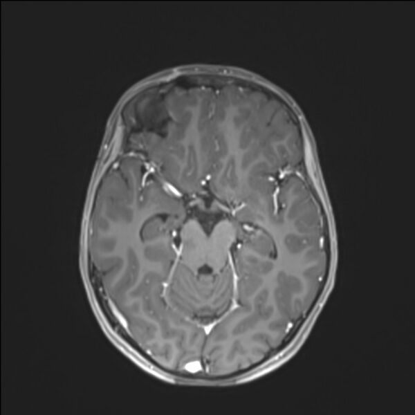 File:Brainstem glioma (Radiopaedia 70548-80674 Axial T1 C+ 68).jpg