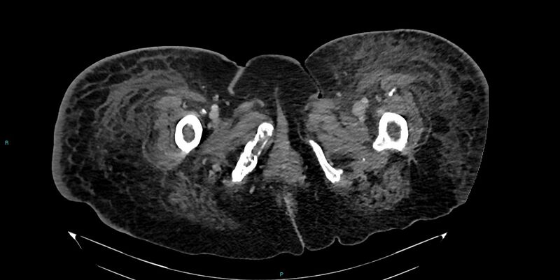 File:Breast cancer pelvic bony metastases (Radiopaedia 84470-99824 Axial bone window 80).jpg