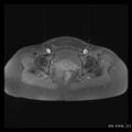 Broad ligament fibroid (Radiopaedia 49135-54241 Axial T1 fat sat 22).jpg