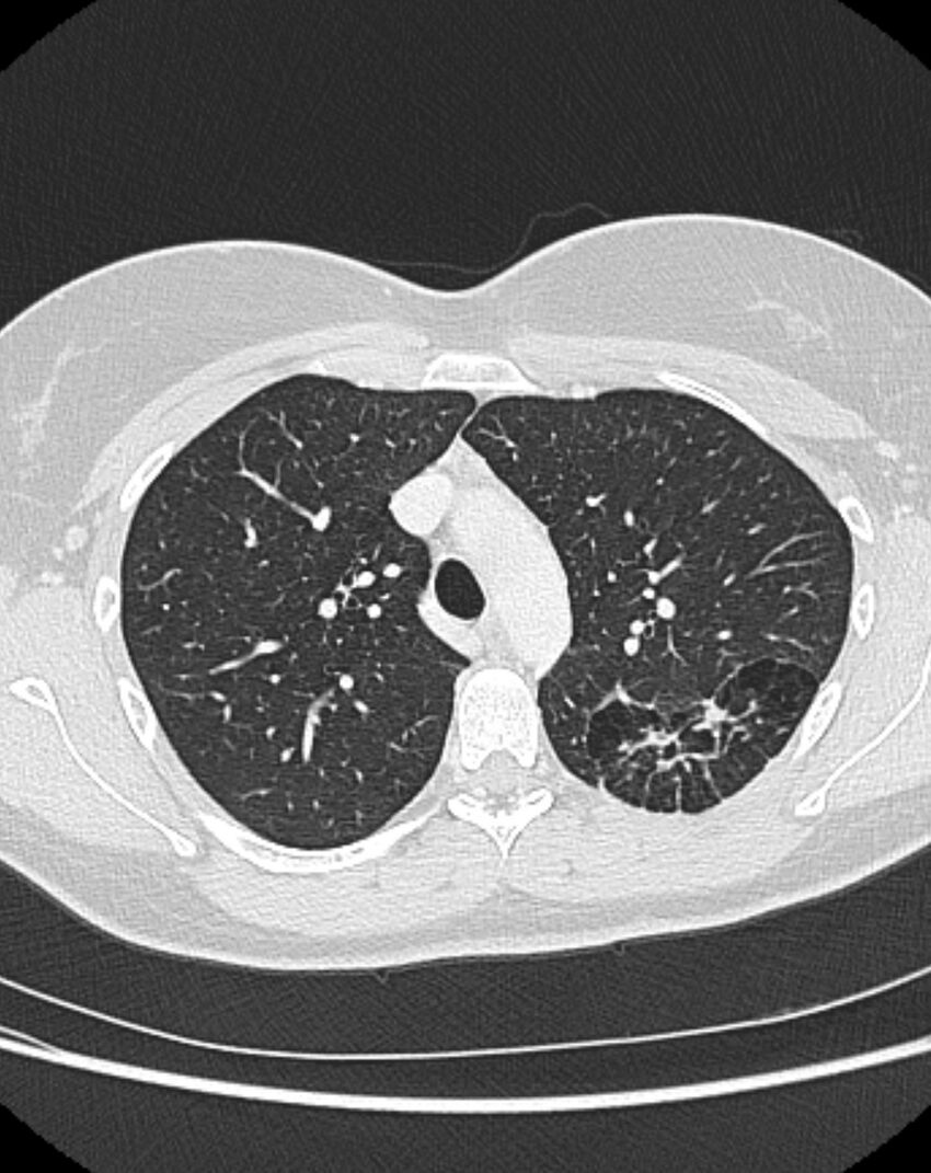 Bronchial atresia (Radiopaedia 50007-55297 Axial lung window 30).jpg