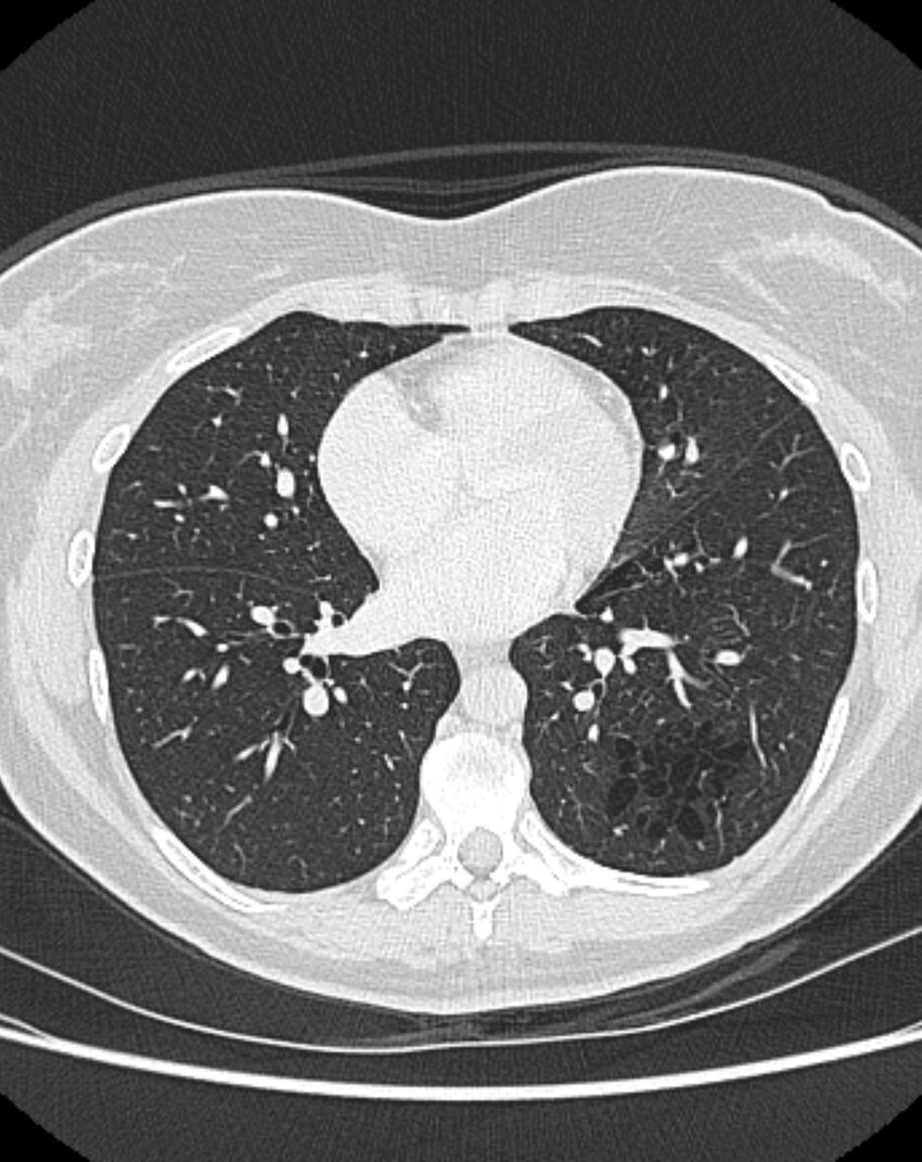 Bronchial atresia (Radiopaedia 50007-55297 Axial lung window 65).jpg