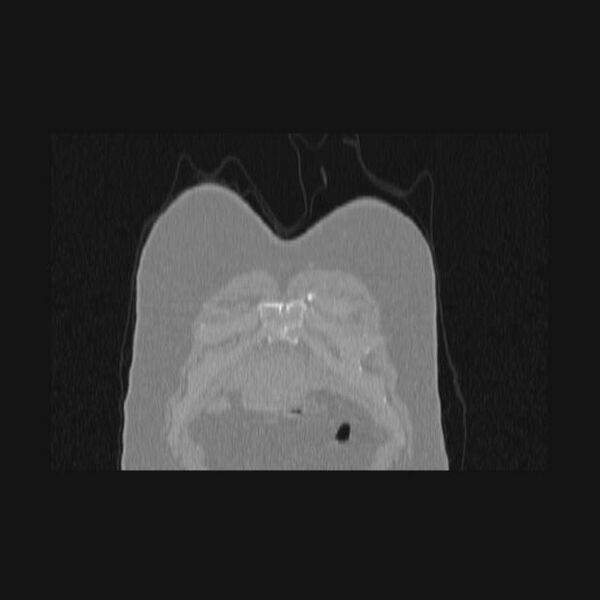 File:Bronchial atresia (Radiopaedia 60685-68439 Coronal lung window 78).jpg