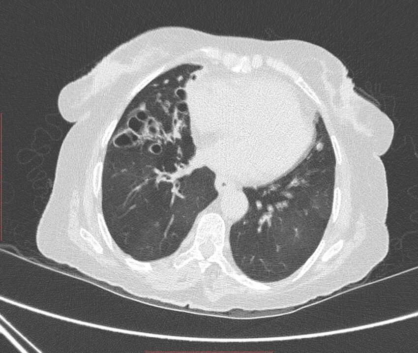 Bronchiectasis (Radiopaedia 72693-83293 Axial lung window 87).jpg