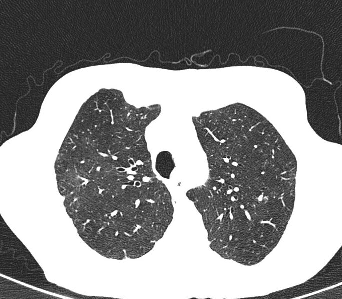 File:Bronchiolitis (Radiopaedia 24616-24887 Axial lung window 11).jpg