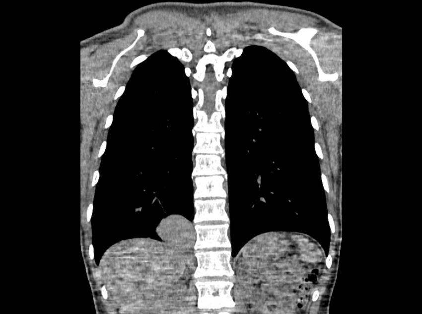 Bronchogenic cyst (Radiopaedia 80273-93615 D 92).jpg