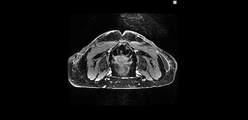 Buttock filler complications (Radiopaedia 63497-72115 Axial T1 C+ 21).jpg
