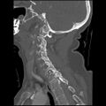 C1 anterior arch (plough) fracture - type 1 (Radiopaedia 76181-87720 Sagittal bone window 44).jpg