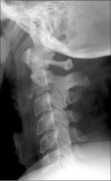 File:C2 teardrop fracture (Radiopaedia 11268-11632 Lateral 1).jpg
