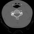 C5 facet fracture (Radiopaedia 58374-65499 Axial bone window 44).jpg