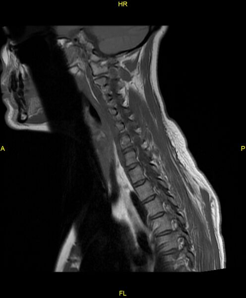 File:C5 nerve sheath tumor (Radiopaedia 85777-101596 Sagittal T1 8).jpg