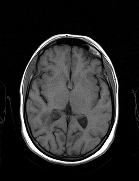 File:Calcified cerebral hydatid cyst (Radiopaedia 65603-74699 Axial T1 12).jpg