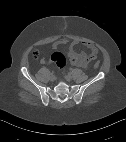 File:Calcified hepatic hydatid cyst (Radiopaedia 81127-94738 Axial non-contrast 75).jpg