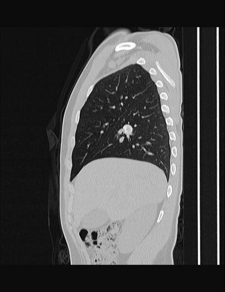 File:Calcifying pulmonary metastases (Radiopaedia 33359-34396 Sagittal lung window 53).jpg