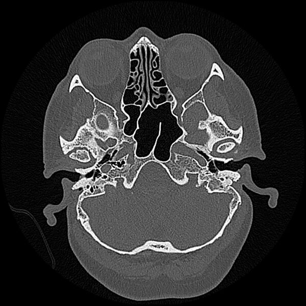 File:Canal up mastoidectomy (Radiopaedia 78108-90638 Axial bone window 49).jpg