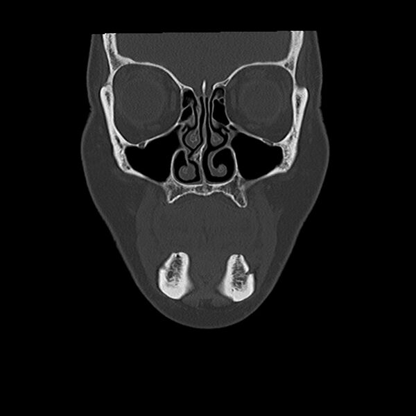 File:Canal up mastoidectomy (Radiopaedia 78108-90638 Coronal bone window 3).jpg