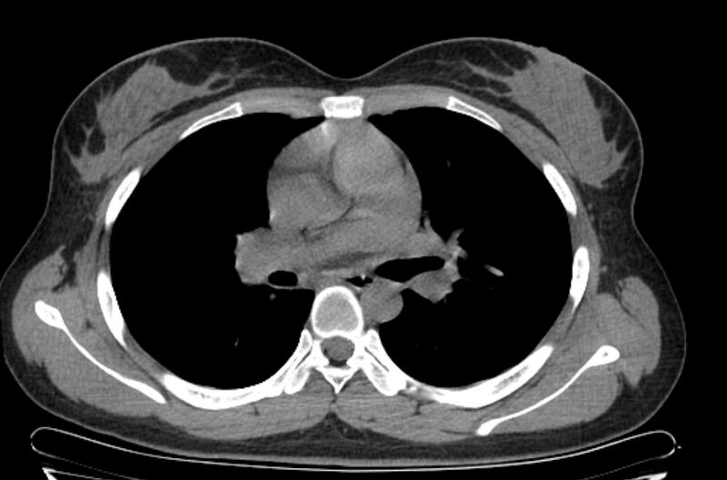 File:Cannonball metastases - uterine choriocarcinoma (Radiopaedia 70137-80173 Axial non-contrast 49).jpg