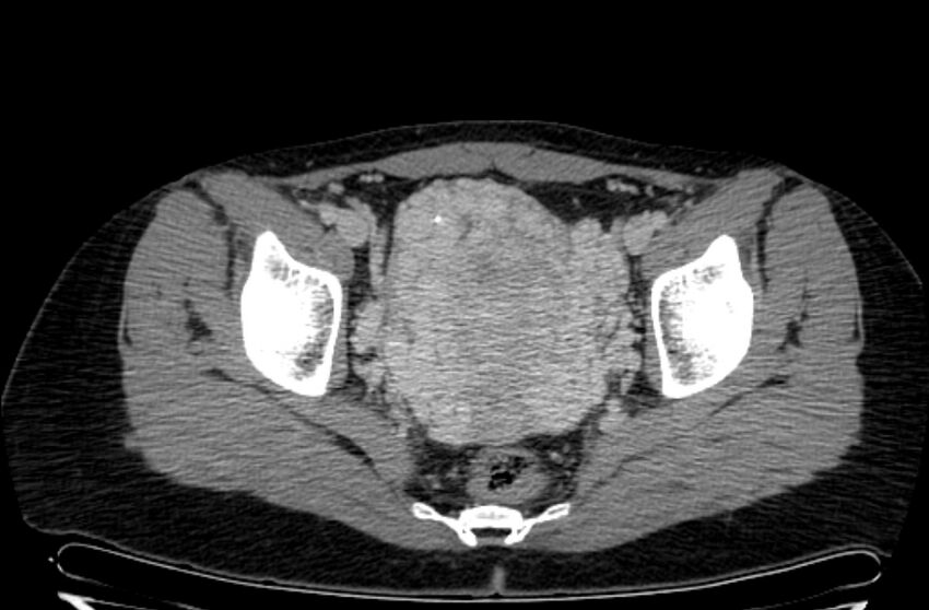 Cannonball metastases - uterine choriocarcinoma (Radiopaedia 70137-80174 A 33).jpg