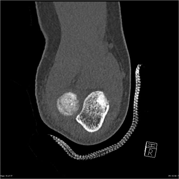 File:Capitellum fracture (Radiopaedia 23352-23426 Coronal bone window 41).jpg