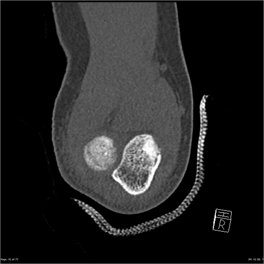 Capitellum fracture (Radiopaedia 23352-23426 Coronal bone window 41).jpg