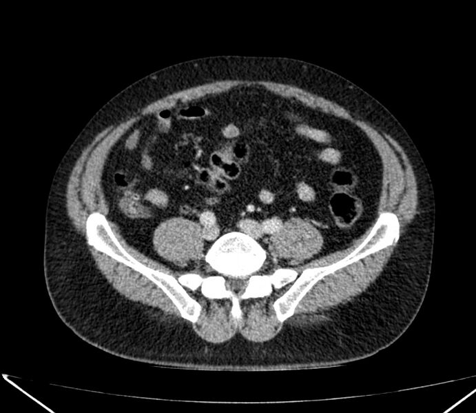 File:Carcinoid tumor with hepatic metastases (Radiopaedia 22651-22670 C 61).jpg