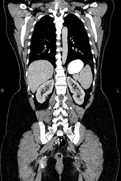 File:Carcinoma of uterine cervix (Radiopaedia 85861-101700 C 41).jpg